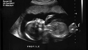 What should you see on a 6 week ultrasound