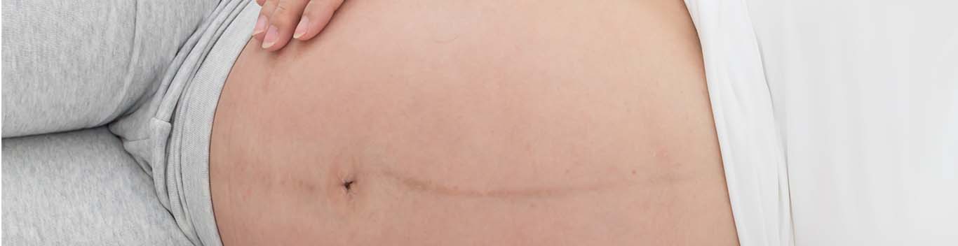 Linea nigra – the dark pregnancy line on my belly bump